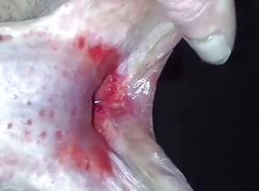Penile Subincision